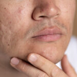 cicatrici da acne