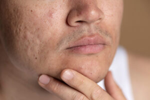 cicatrici da acne